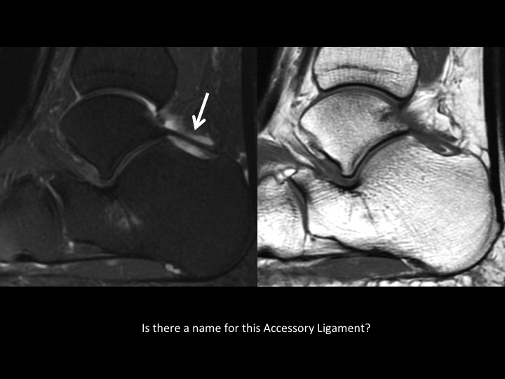 Figure 3 for case talocalcaneal joint ( RID3030 )